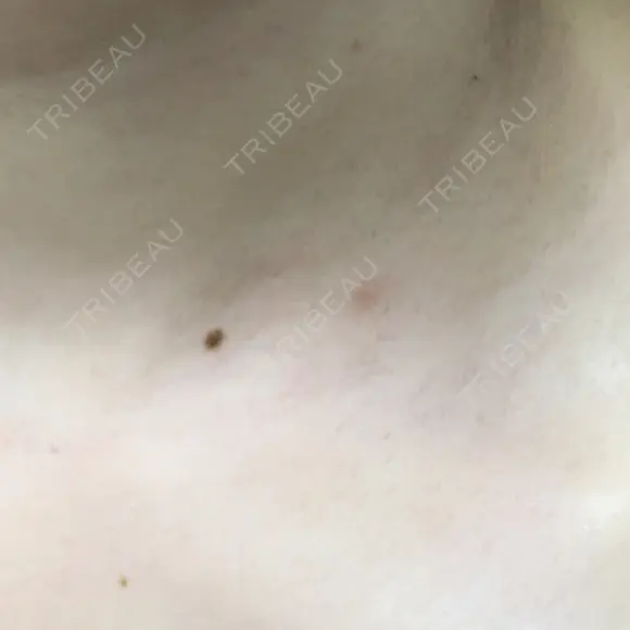 ほくろ・いぼ切除（肌） リメイ皮膚科 DAY 9 メイン用