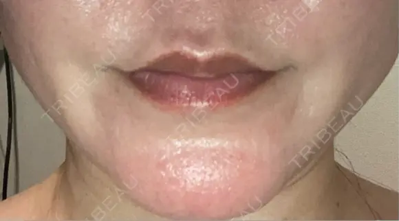 ボトックス（人中） BON BON CLINIC 銀座駅前本院 DAY 2 メイン用