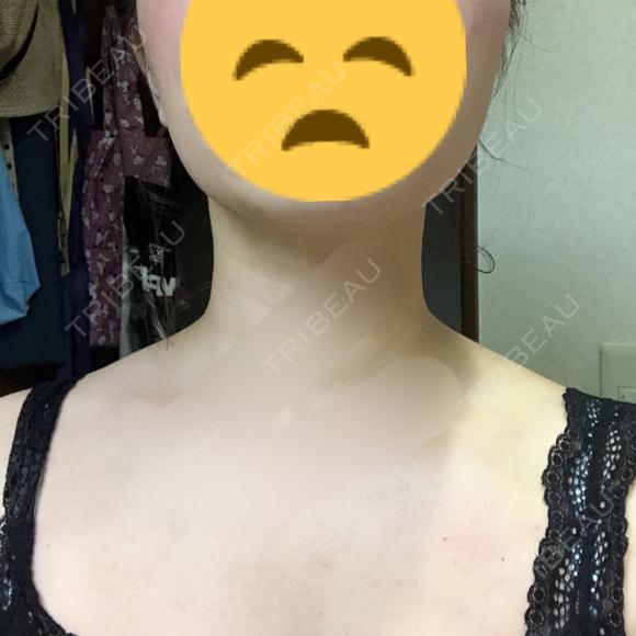 ボトックス（肩） リエンジャン整形外科 江南店 AFTER メイン用