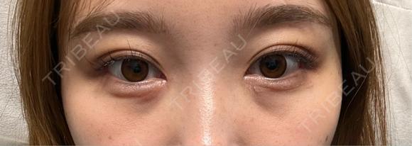 目頭切開 / 目尻切開 / 自然癒着法 / ヒアルロン酸注入（涙袋） LUHO（ルホ）美容外科 AFTER メイン用