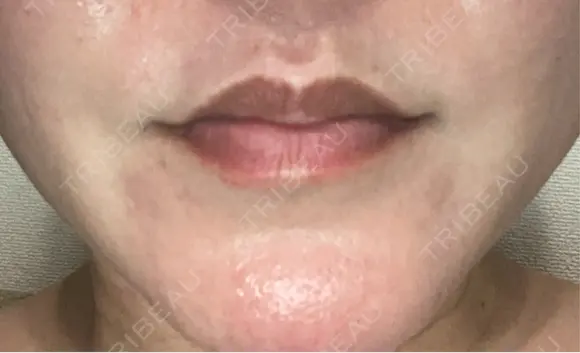 ボトックス（人中） BON BON CLINIC 銀座駅前本院 DAY 3 メイン用