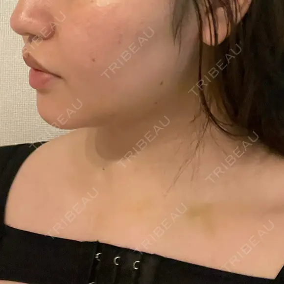 脂肪吸引（顔） / 脂肪吸引（二の腕） 湘南美容クリニック 京都院 DAY 13 メイン用