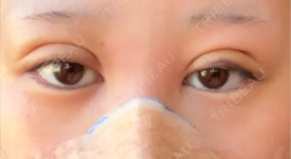 二重埋没 / 鼻尖形成（切開） / 鼻尖縮小 / 小鼻縮小（非切開） R Beauty CLINIC 大阪院 DAY 2 メイン用