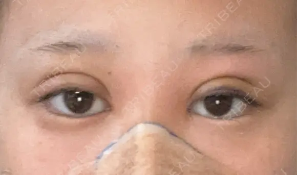 二重埋没 / 鼻尖形成（切開） / 鼻尖縮小 / 小鼻縮小（非切開） R Beauty CLINIC 大阪院 DAY 3 メイン用
