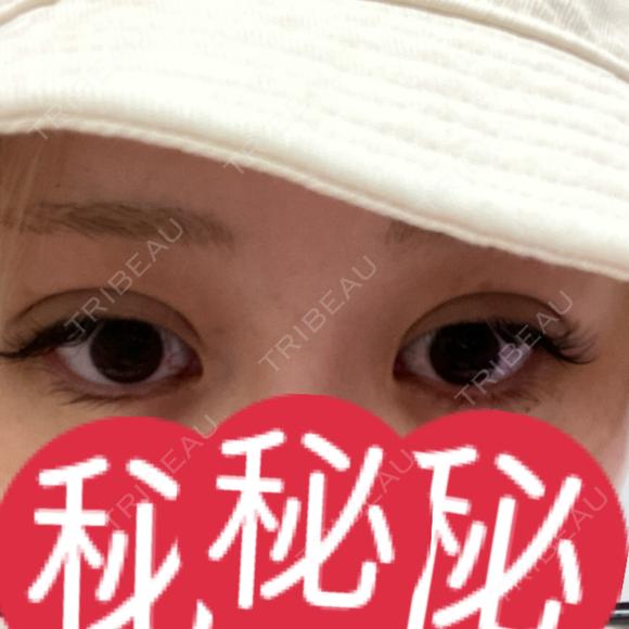 二重埋没 / ボトックス（エラ・小顔） 吉祥寺アイビークリニック DAY 1 メイン用