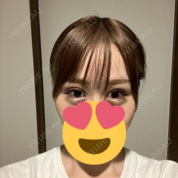 二重埋没 / ボトックス（エラ・小顔） 吉祥寺アイビークリニック DAY 3 メイン用