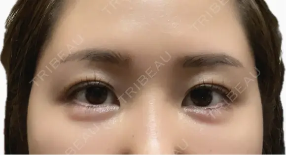 ヒアルロン酸注入（目の下） / ボトックス（眉間） CLINIC W AFTER メイン用