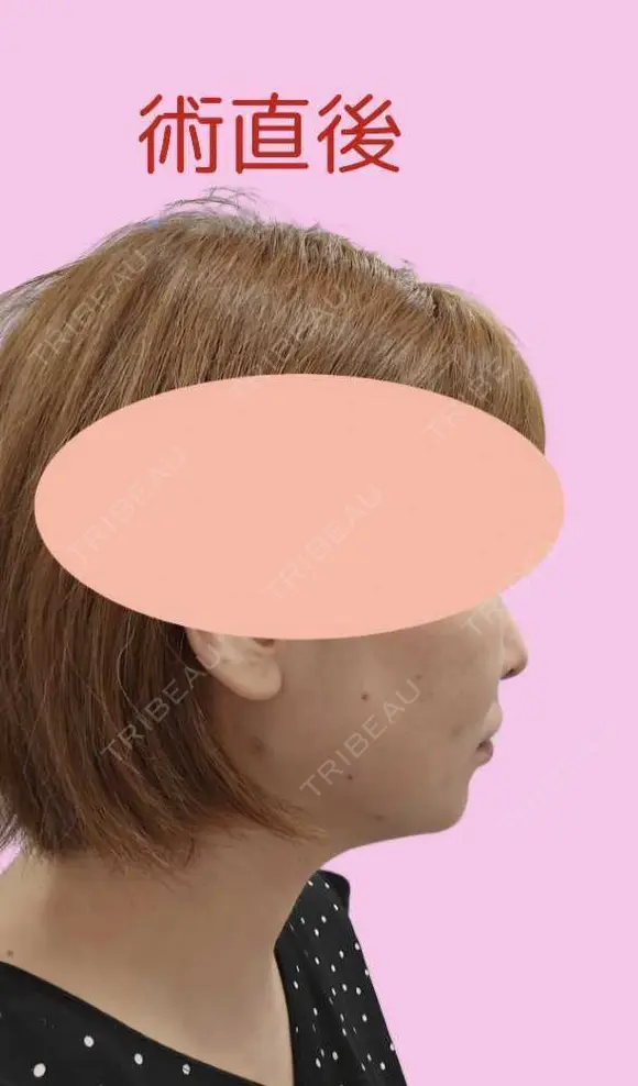 糸リフト / 脂肪吸引（顔） / メーラーファット除去 / ジョールファット除去 / 脂肪吸引注射（顔） ziz CLINIC DAY 0 メイン用