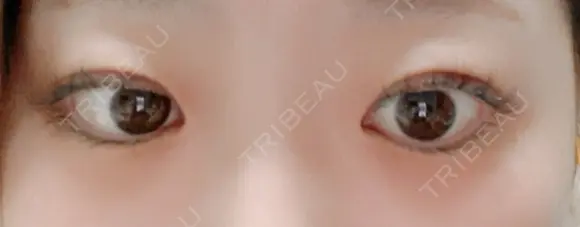 二重埋没 東京シンデレラ美容外科 大宮院 DAY 1 メイン用