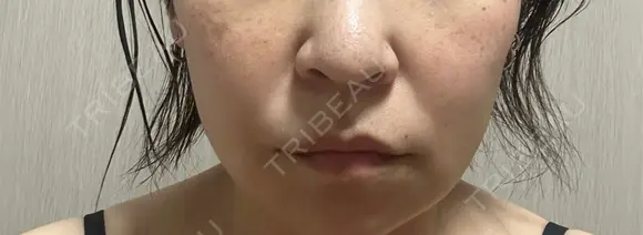 脂肪溶解注射（顔） ROOTS Clinic DAY 7 メイン用