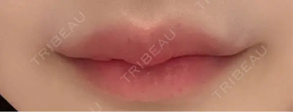 ヒアルロン酸注入（唇） / ボトックス（口角） KAGA CLINIC DAY 1 メイン用