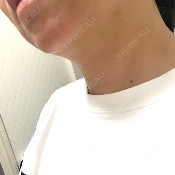 脂肪溶解注射（顔） / ハイフ（顔） AZ BEAUTY CLINIC DAY 1 メイン用
