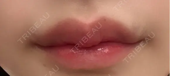 ヒアルロン酸注入（唇） / ボトックス（口角） KAGA CLINIC DAY 2 メイン用