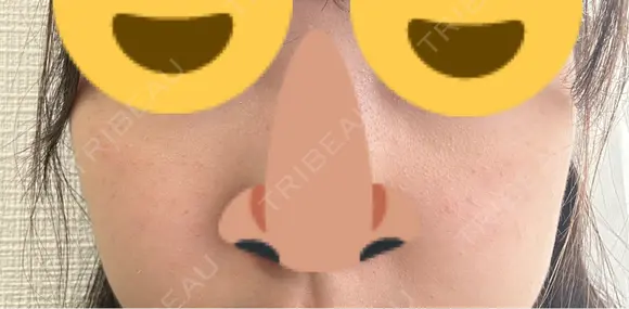 毛穴洗浄（ハイドラフェイシャルなど） / ピコレーザートーニング（美白・肝斑） アーククリニック DAY 5 メイン用