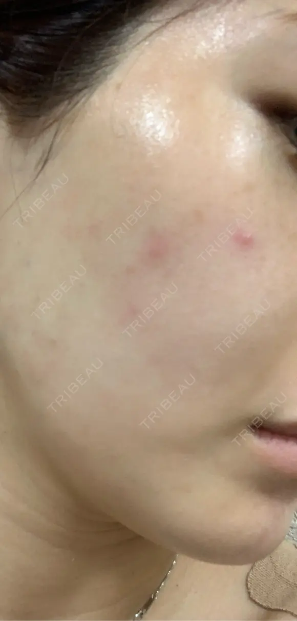 美容点滴・美容注射（ダイエット） / 美容点滴・美容注射（疲労回復） / ピコレーザートーニング（美白・肝斑） / ピーリング（ハリ・ツヤ） / ピコフラクショナルレーザー（毛穴・ニキビ跡） 表参道メディカルクリニック 大阪院 DAY 1 メイン用