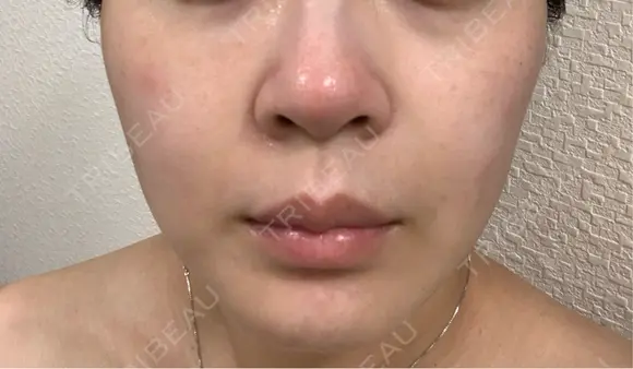 美容点滴・美容注射（ダイエット） / 美容点滴・美容注射（疲労回復） / ピコレーザートーニング（美白・肝斑） / ピーリング（ハリ・ツヤ） / ピコフラクショナルレーザー（毛穴・ニキビ跡） 表参道メディカルクリニック 大阪院 DAY 2 メイン用