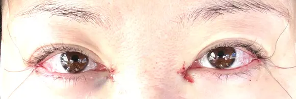 目頭切開 / 目尻切開 EMMA CLINIC（エマクリニック） DAY 0 メイン用