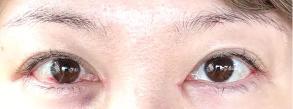 目頭切開 / 目尻切開 EMMA CLINIC（エマクリニック） DAY 7 メイン用