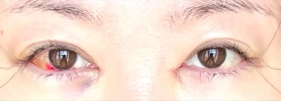 目頭切開 / 目尻切開 EMMA CLINIC（エマクリニック） DAY 3 メイン用