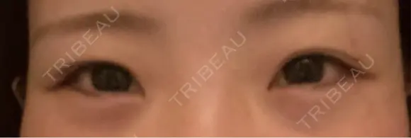 クマ治療 / ヒアルロン酸注入（目の下） ROOTS Clinic AFTER メイン用