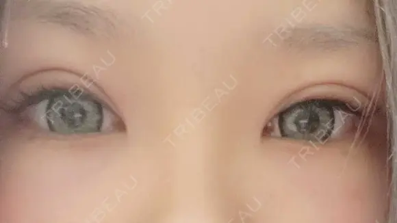 二重埋没 アリエル美容クリニック 郡山院 DAY 29 メイン用