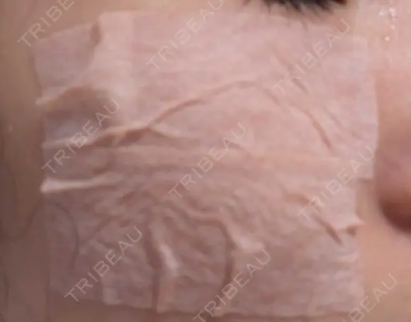 シミ取りレーザー / その他（目元） 共立美容外科 仙台院 DAY 5 メイン用