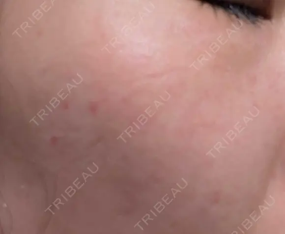 シミ取りレーザー / その他（目元） 共立美容外科 仙台院 DAY 6 メイン用