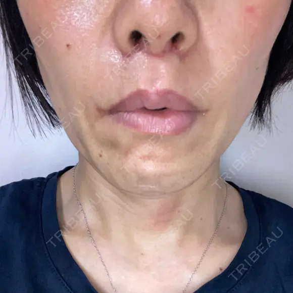 人中短縮 / 口角挙上 / その他（口元） ルラ美容クリニック 神戸院 DAY 33 メイン用