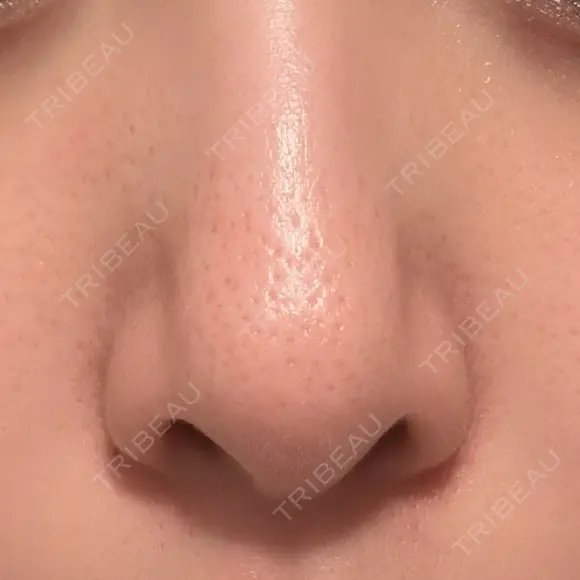 その他（肌） 代官山ウィメンズクリニック AFTER メイン用