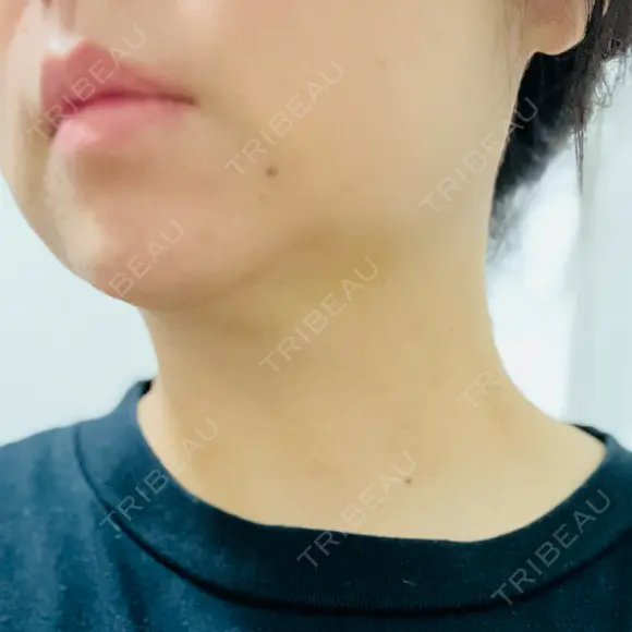 脂肪溶解注射（顔） / ハイフ（顔） AZ BEAUTY CLINIC DAY 4 メイン用