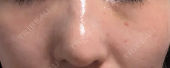 シミ取りレーザー / その他（目元） 共立美容外科 仙台院 DAY 7 メイン用