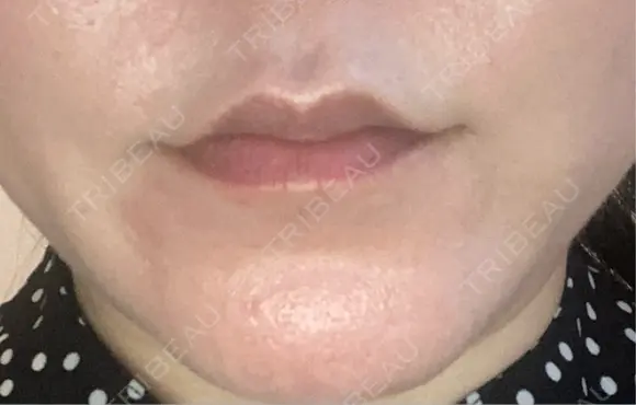 ボトックス（人中） BON BON CLINIC 銀座駅前本院 DAY 4 メイン用