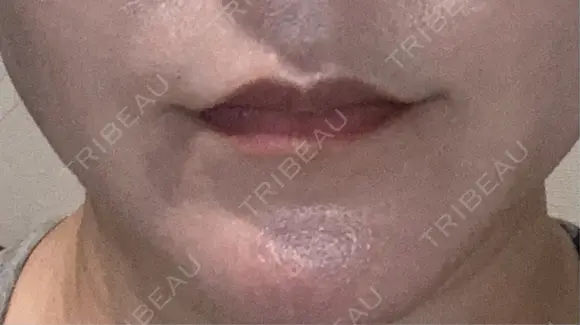 ボトックス（人中） BON BON CLINIC 銀座駅前本院 DAY 5 メイン用