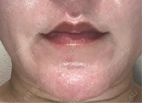 ボトックス（人中） BON BON CLINIC 銀座駅前本院 DAY 6 メイン用