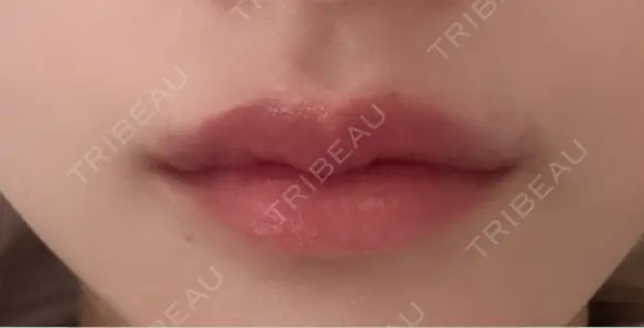 ヒアルロン酸注入（唇） / ボトックス（口角） KAGA CLINIC DAY 6 メイン用