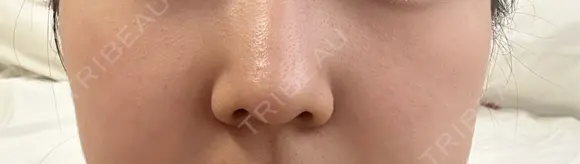 毛穴洗浄（ハイドラフェイシャルなど） / ピコレーザートーニング（美白・肝斑） アーククリニック DAY 10 メイン用