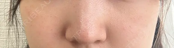 毛穴洗浄（ハイドラフェイシャルなど） / ピコレーザートーニング（美白・肝斑） アーククリニック DAY 11 メイン用