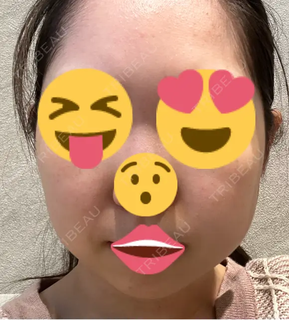 毛穴洗浄（ハイドラフェイシャルなど） / ピコレーザートーニング（美白・肝斑） アーククリニック AFTER メイン用