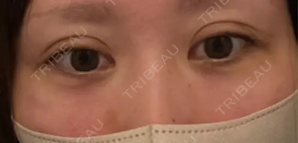 クマ治療 / 下まぶたの脂肪取り / ヒアルロン酸注入（目の下） ROOTS Clinic DAY 0 メイン用