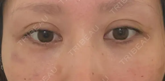 クマ治療 / 下まぶたの脂肪取り / ヒアルロン酸注入（目の下） ROOTS Clinic DAY 0 メイン用