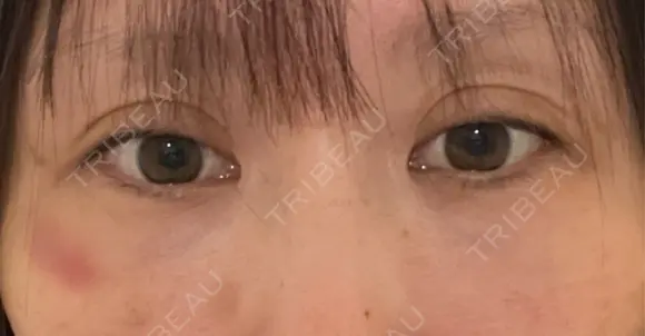 クマ治療 / 下まぶたの脂肪取り / ヒアルロン酸注入（目の下） ROOTS Clinic DAY 1 メイン用