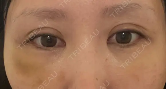 クマ治療 / 下まぶたの脂肪取り / ヒアルロン酸注入（目の下） ROOTS Clinic DAY 2 メイン用