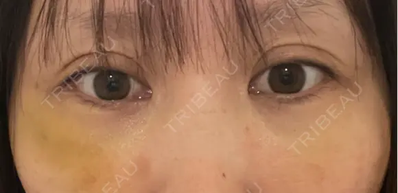 クマ治療 / 下まぶたの脂肪取り / ヒアルロン酸注入（目の下） ROOTS Clinic AFTER メイン用