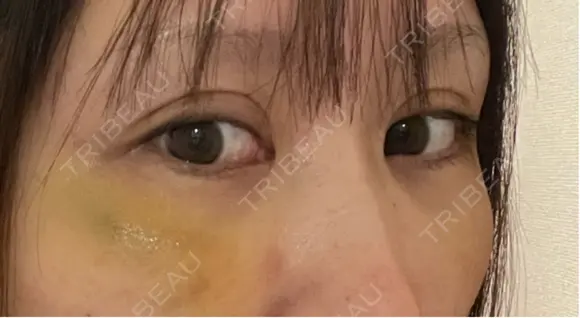 クマ治療 / 下まぶたの脂肪取り / ヒアルロン酸注入（目の下） ROOTS Clinic DAY 3 メイン用