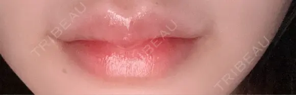 ヒアルロン酸注入（唇） / ボトックス（口角） KAGA CLINIC DAY 7 メイン用