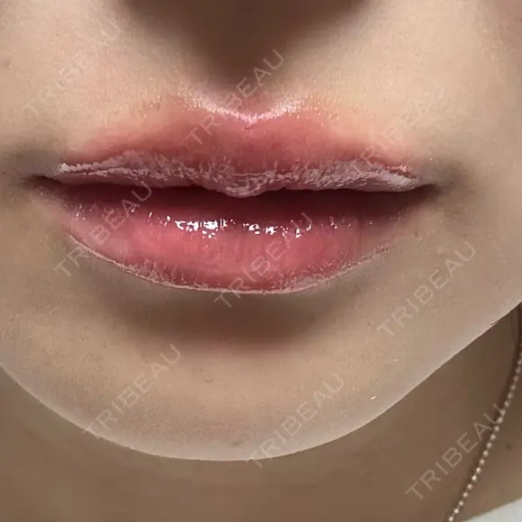 ヒアルロン酸注入（涙袋） / ヒアルロン酸注入（唇） 東京シンデレラ美容外科 大宮院 AFTER メイン用