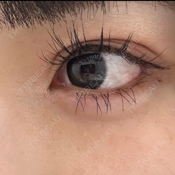 ヒアルロン酸注入（涙袋） / ヒアルロン酸注入（唇） 東京シンデレラ美容外科 大宮院 DAY 1 メイン用