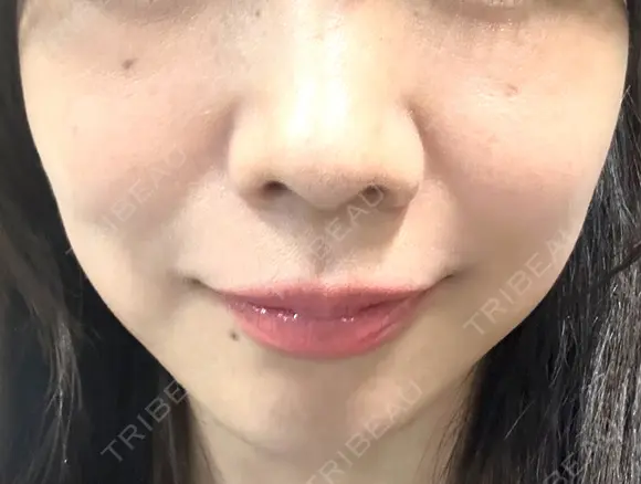 光治療（フォトフェイシャルなど） 大美会クリニック 岡山院 DAY 33 メイン用