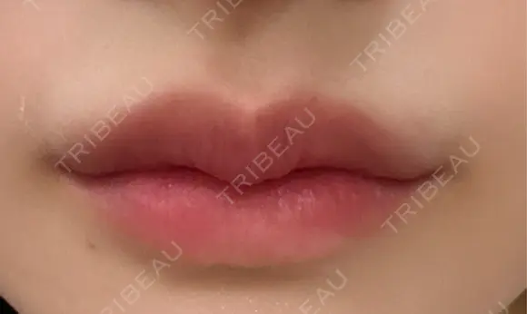 ヒアルロン酸注入（唇） / ボトックス（口角） KAGA CLINIC DAY 8 メイン用