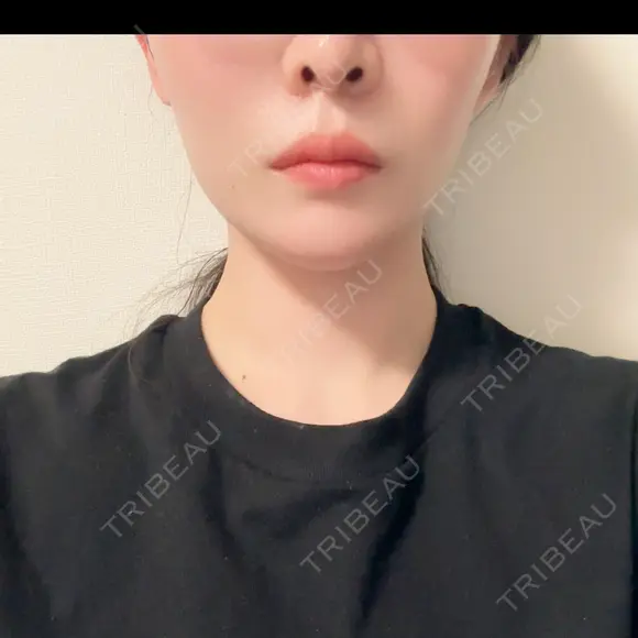 RF（高周波）たるみ治療 ルラ美容クリニック 渋谷本院 AFTER メイン用